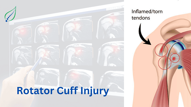 Rotator Cuff Injury